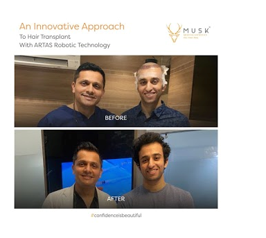 Hair Transplant in Ahmedabad