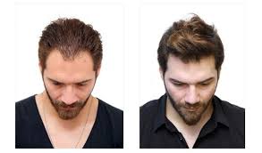 Best Hair Transplants Treatment in Chandigarh