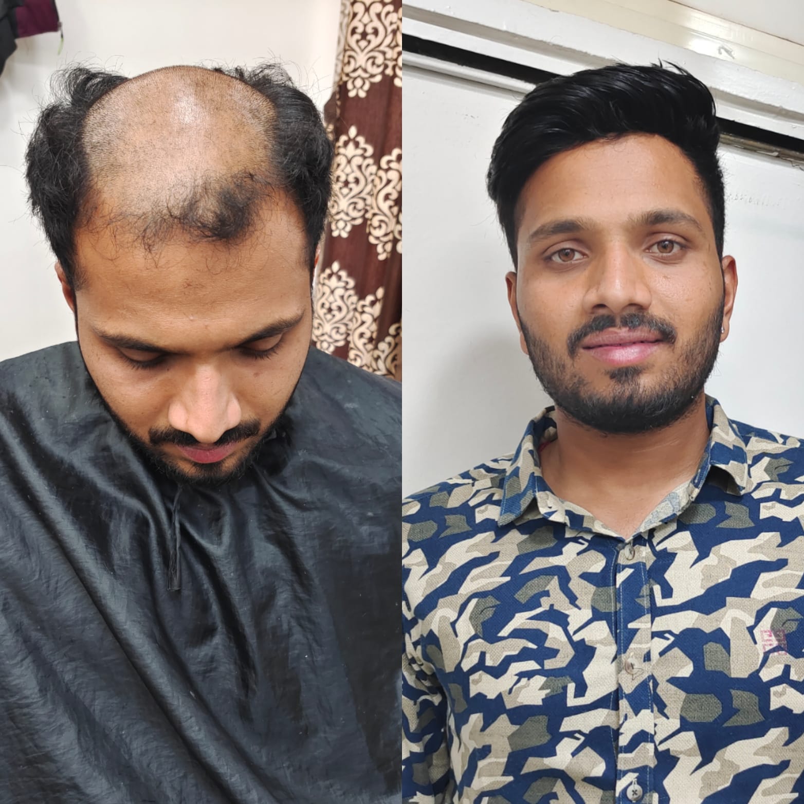 Hair Loss Solutions in Pune Viman Nagar | Patricks Hair