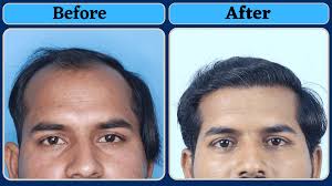 Hair transplant in Jaipur - IFT Hair Science