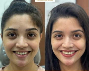 Invisalign Aligners Provider – Pune