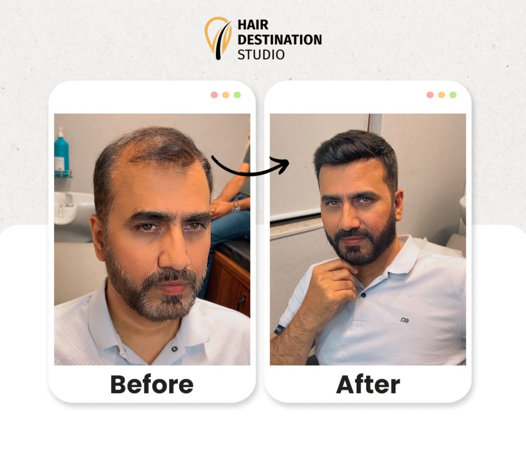 Hair Replacement Service in Mumbai | Hair Destination Studio