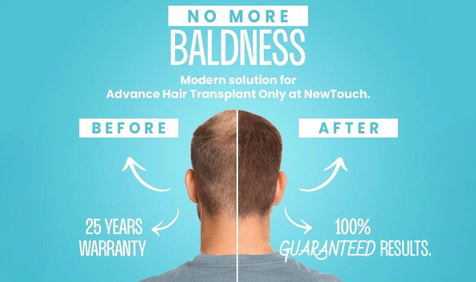 Hair Transplant Clinic in Ahmedabad