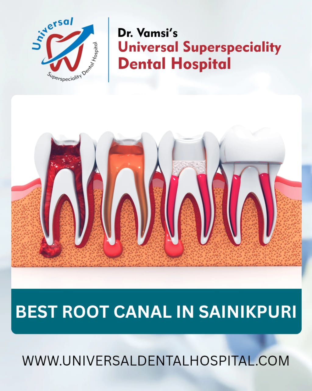 https://www.universaldentalhospital.com/root-canal-specialist/