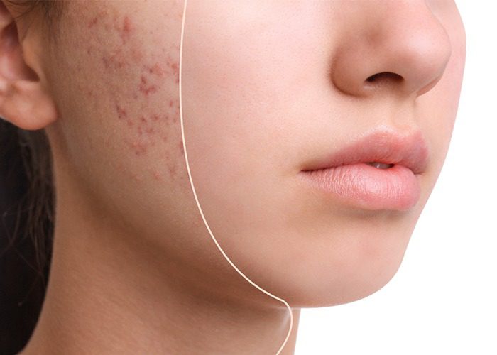 Acne Scar Treatment – Restore Your Skin’s Natural Beauty