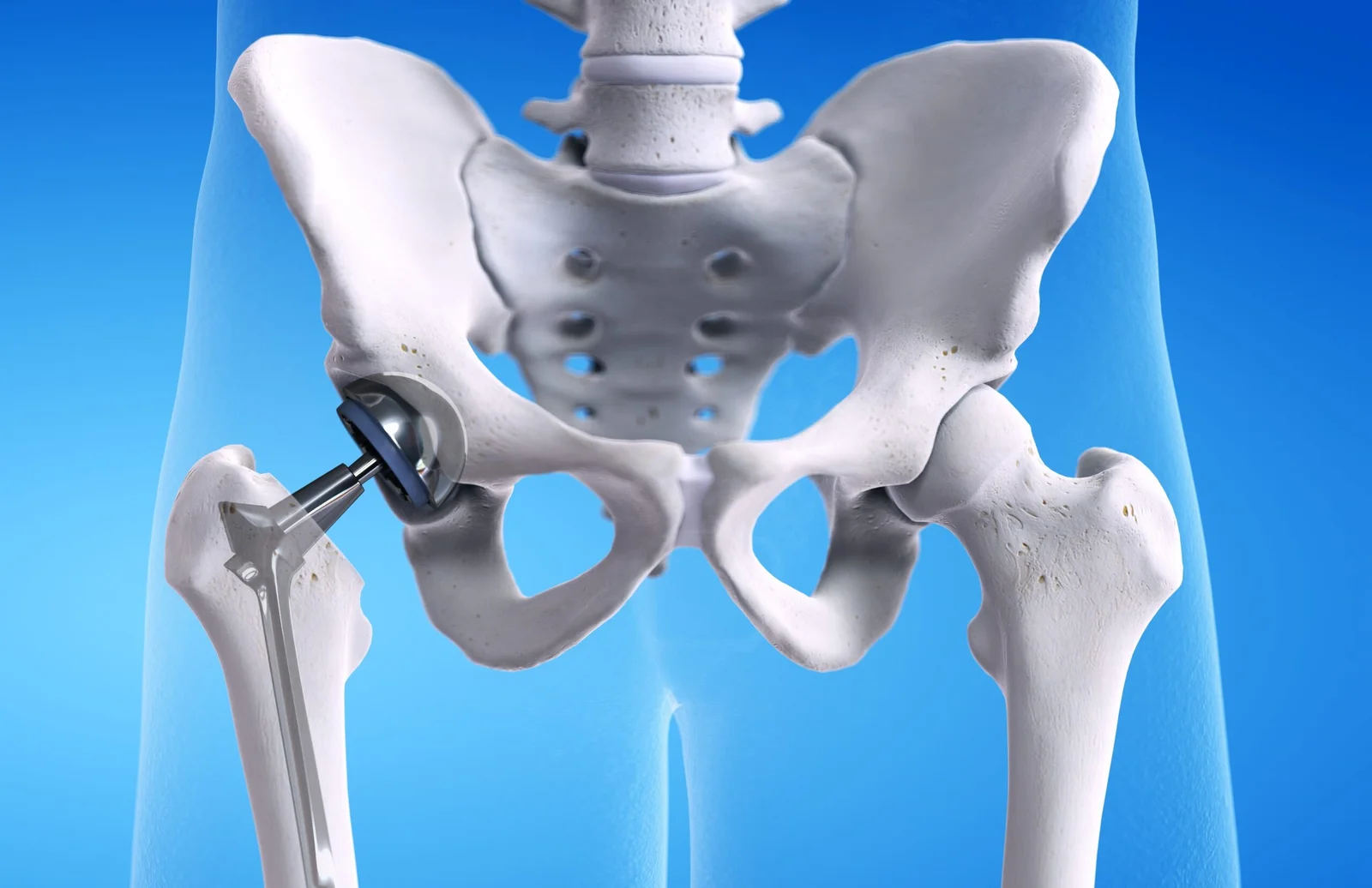Hip Replacement Surgery by Dr. Vijay Bose