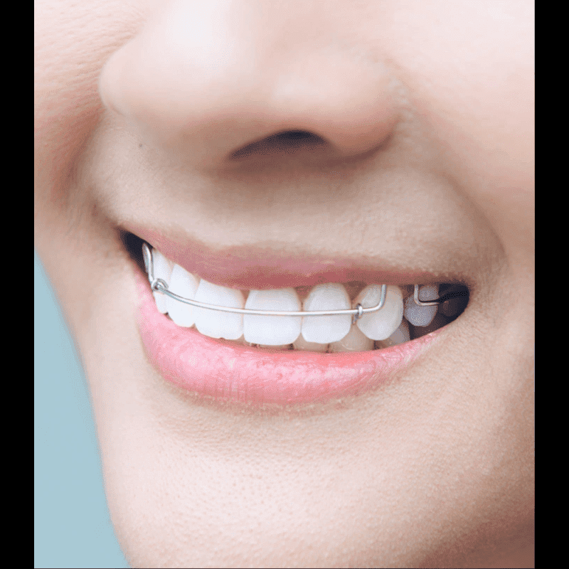 One Dentall | Invisible Aligners | Belgaum