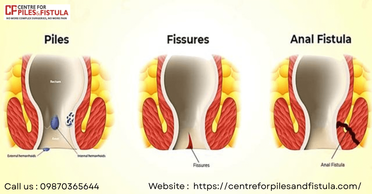 Centre For Pilesand Fistula