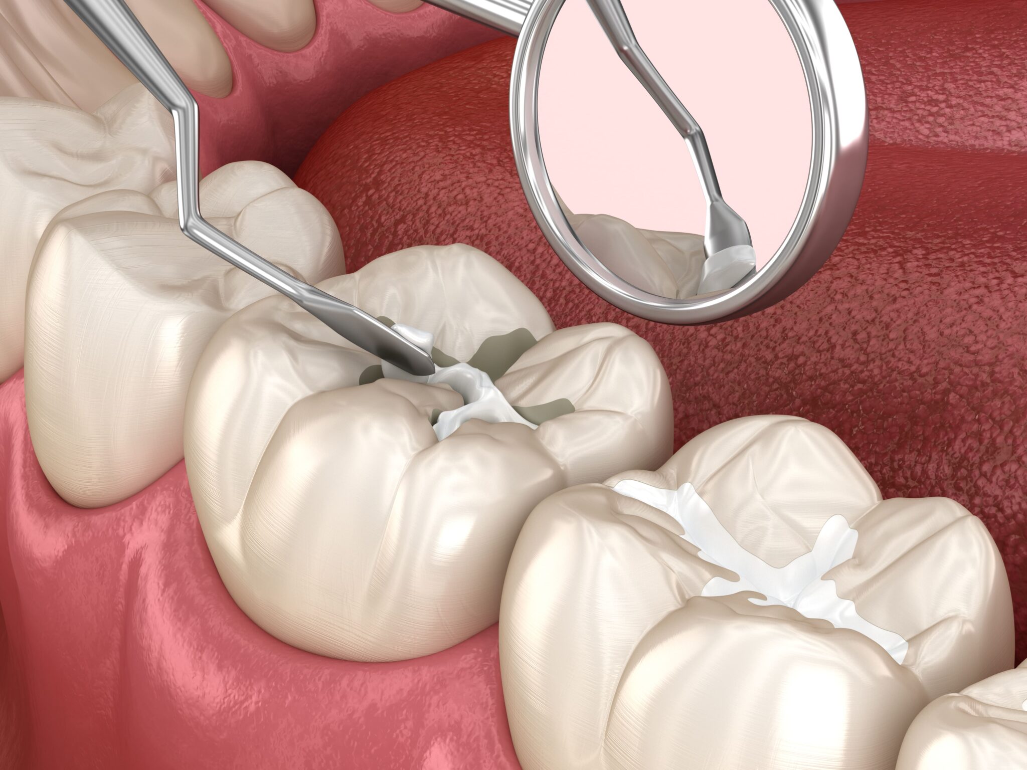 Dental Tooth Filling in Dubai