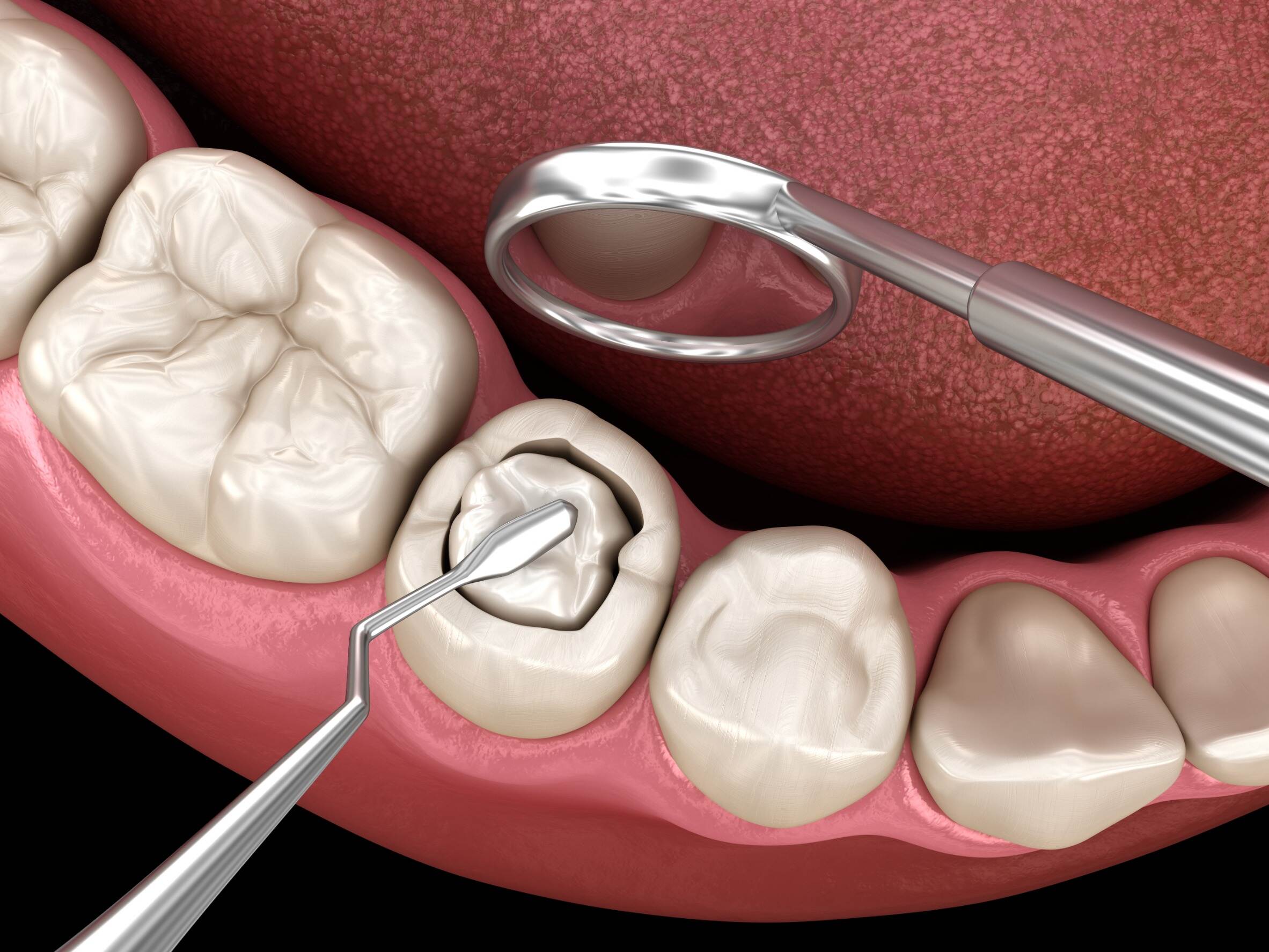 Dental Tooth Filling in Dubai