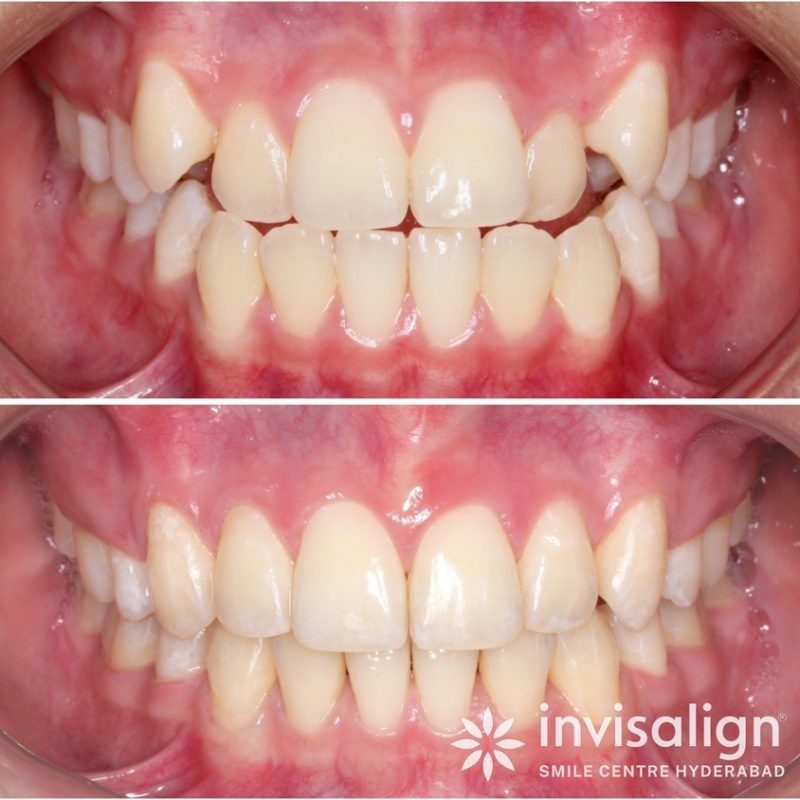 Invisalign® Smile Centre – Hyderabad
